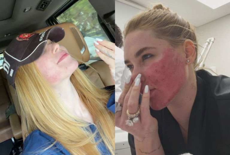 Virginia se arrepende após procedimento estético no rosto