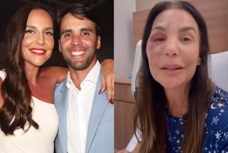 Ex-marido de Ivete Sangalo fala sobre cirurgia da cantora: “Mulher de aço”